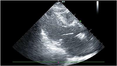 Case report: Cefoperazone-sulbactam induced Kounis syndrome and cardiogenic shock